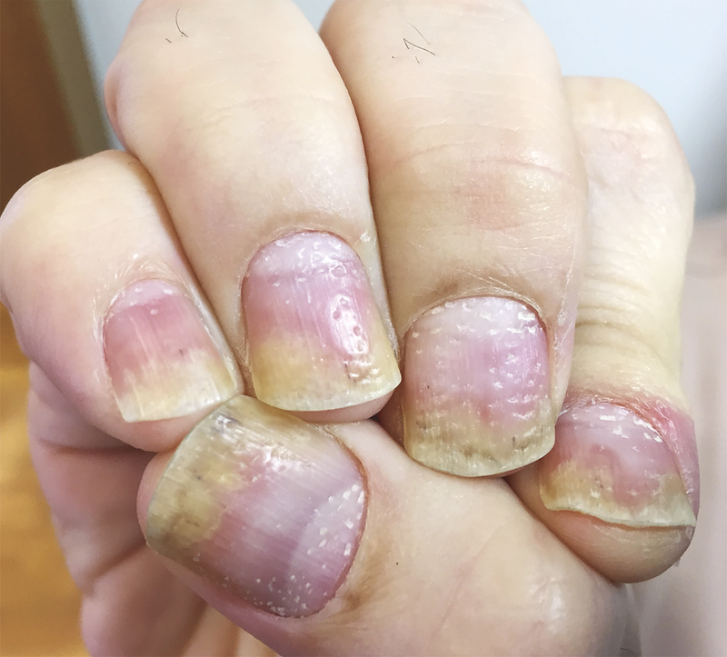 Thiếu hụt chất dinh dưỡng khiến cho móng bị yếu, dễ gãy