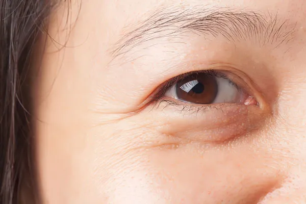 Mắt sụp mí với mí mắt trên che khuất con ngươi