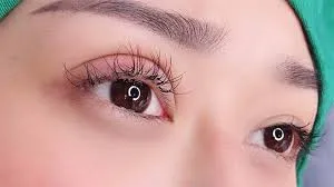 Dấu hiệu nhận biết mi nối bị rối và xô lệch cần xử lý