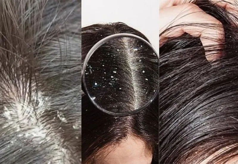 Da đầu nhiều gàu và vảy trắng